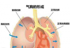 创伤性气胸分为哪三类？