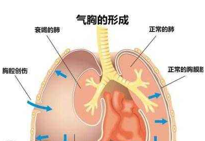 创伤性气胸的示意图