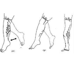 静脉曲张怎么办?老中医推荐您治疗下肢静脉曲张的偏方。