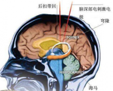 脑外伤伴发的精神障碍的症状表现及其治疗方法！