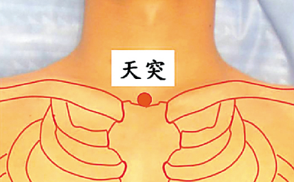 天突穴埋线治疗慢性咽炎