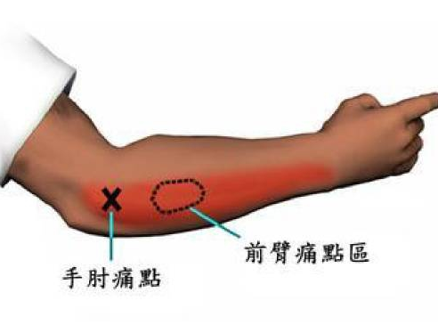 肘髎穴图片