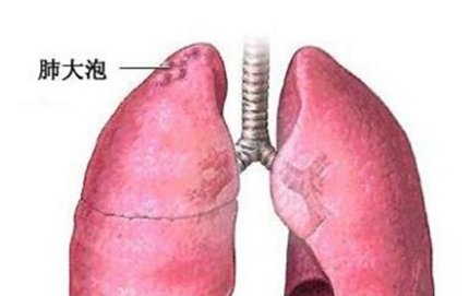 肺大泡的发病原因