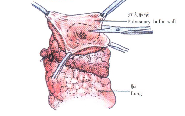 肺大泡的疾病鉴别