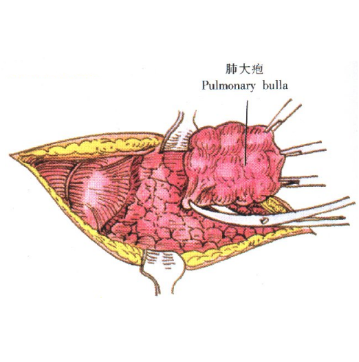 肺大疱的症状表现及其临床诊断方法与治疗方法有哪些？