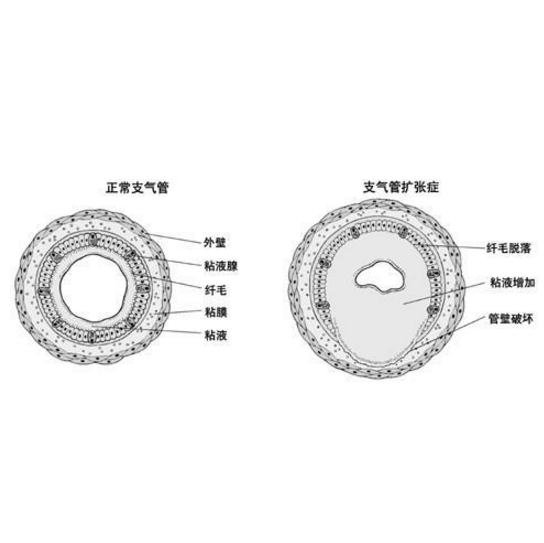 什么是肺囊性纤维化？肺囊性纤维化的症状表现及其治疗方法有哪些？