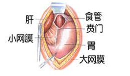 贲门失弛缓症