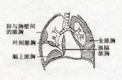 胆固醇脓胸的疾病鉴别及其护理方法！