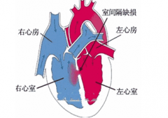 单心房的症状表现及其治疗方法有哪些？