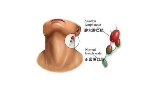 肺假性淋巴瘤的发病原因