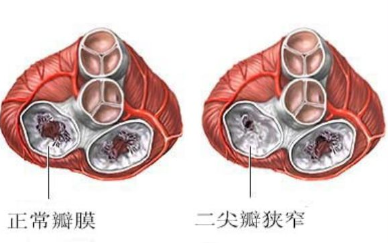 二尖瓣狭窄