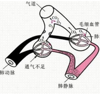 肺泡通气低下综合征如何诊断？它的症状表现及其治疗方法有哪些？