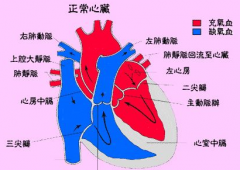 风湿性二尖瓣狭窄可以治好吗？风湿性二尖瓣狭窄的症状表现