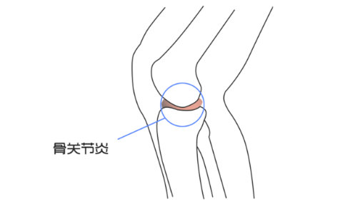 关节炎食疗