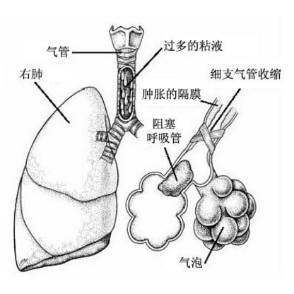 肺炎是由哪些原因引起的，其早期症状与治疗方法有哪些？